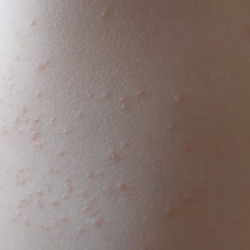Çocuk Bikinilerinde Alerjik Reaksiyon, Sağlık Riski Ve İade Talebi
