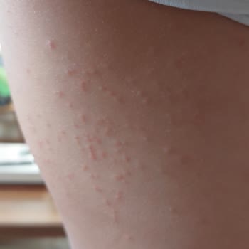 Çocuk Bikinilerinde Alerjik Reaksiyon, Sağlık Riski Ve İade Talebi