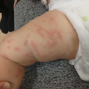 Bioderma Atoderm Kremi Bebekte Şiddetli Alerjik Reaksiyon