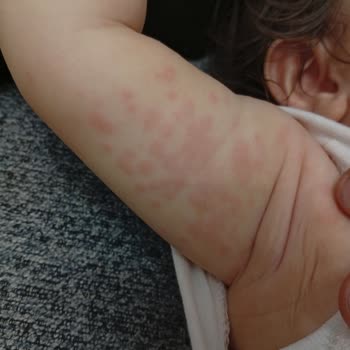 Bioderma Atoderm Kremi Bebekte Şiddetli Alerjik Reaksiyon