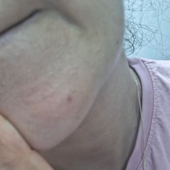 Lazer Ve Hydrafacial İşlemlerinde Profesyonellik Eksikliği Ve İade Reddi