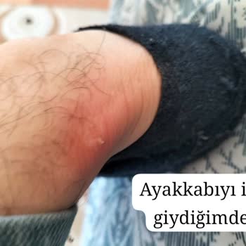 Lacoste Sneaker'da Şiddetli Tahriş Ve İade Reddi