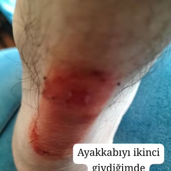 Lacoste Sneaker'da Şiddetli Tahriş Ve İade Reddi