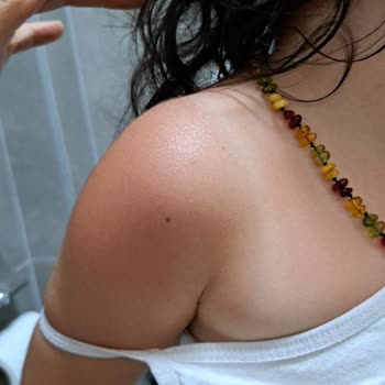 Mustela Güneş Koruyucu Losyonu Çocuğumu Yaktı