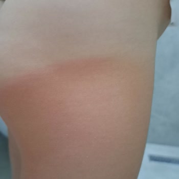 Mustela Güneş Koruyucu Losyonu Çocuğumu Yaktı