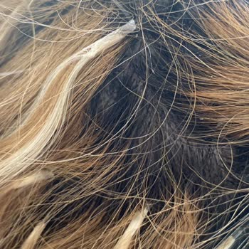 Kalitesiz Keratin Kaynak İşlemi Sonrası Aşırı Kaşıntı Ve Saç Dökülmesi