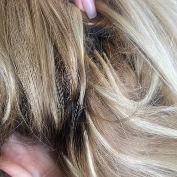 Kalitesiz Keratin Kaynak İşlemi Sonrası Aşırı Kaşıntı Ve Saç Dökülmesi