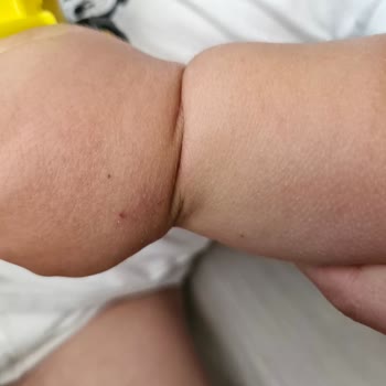Deneyimsiz Personelin Çocuğuma Sekiz Kez Damar Yolu Açması
