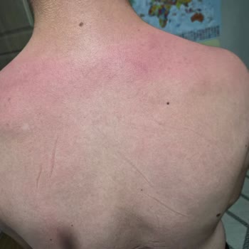 Sebamed Güneş Kremi Çocuklarda Şiddetli Yanıklara Ve Ağrıya Yol Açtı