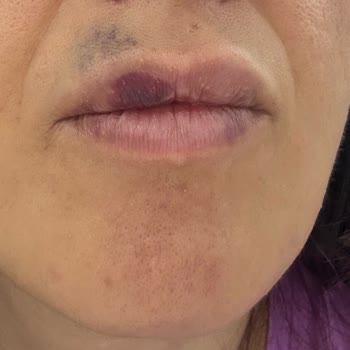 Yüzyıl Pendik Hastanesi Kendi Paramla Resmen Mağdur Edildim
