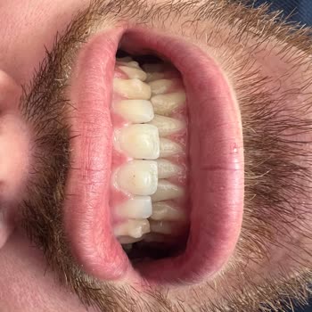 Crystal Aligner Klinik Olarak Güven Kaybı Yaşadık