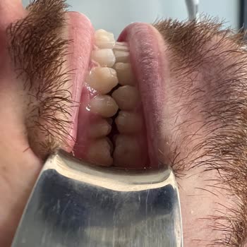 Crystal Aligner Klinik Olarak Güven Kaybı Yaşadık