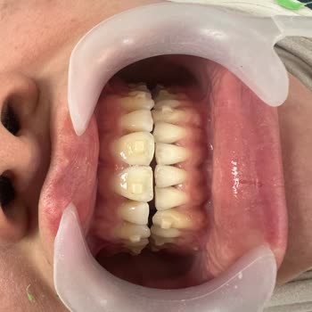 Crystal Aligner Klinik Olarak Güven Kaybı Yaşadık