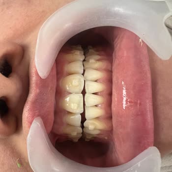 Crystal Aligner Klinik Olarak Güven Kaybı Yaşadık