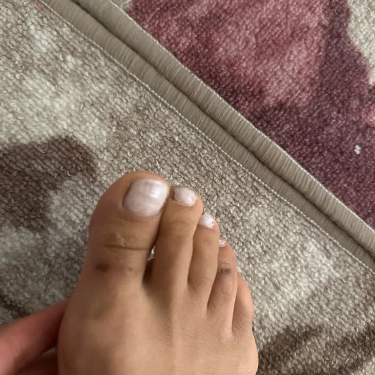 Sağlığıma Zarar Veren Ve Kısa Sürede Yırtılan Sandalet İçin İade Talebi