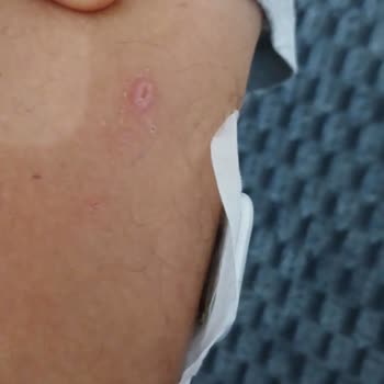 Defolu Glukoz Sensörleri Nedeniyle Ağrı Okunamayan Ölçüm Ve Tam İade Talebi
