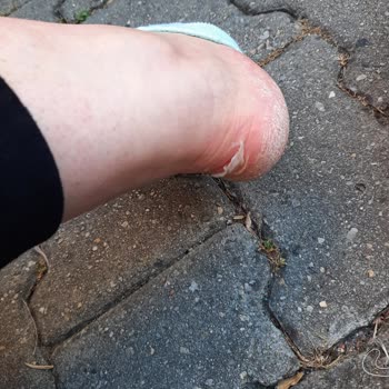 Intersport Ayak Kesilmesine Neden Olan Spor Ayakkabıda Değişim Ve İade Talebi