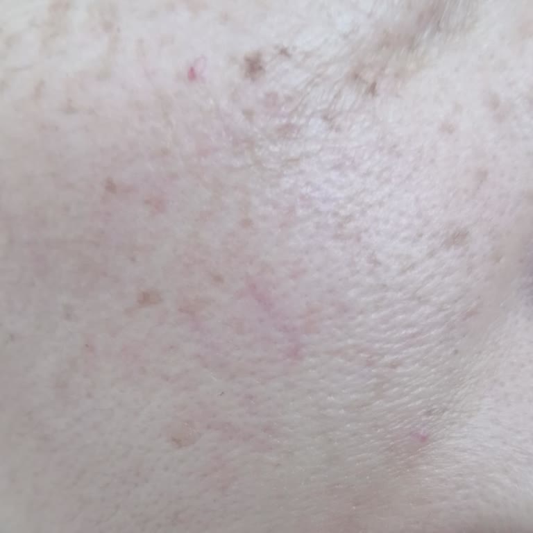 Bioderma Ürünü Cildimde Tahriş Oluşturdu Ve Geri Dönüş Sağlanmadı