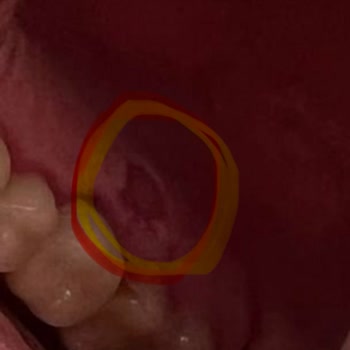 Sensodyne Beyazlatıcı Diş Macunu Ağızda Deri Soyulması Yaptı Ve Tazminat Talep Ediliyor