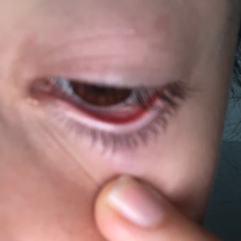 Göz Yakmayan Formül İddiası Yanıltıcı: Bebek Şampuanı Göz Yakarak Kızarıklığa Yol Açtı
