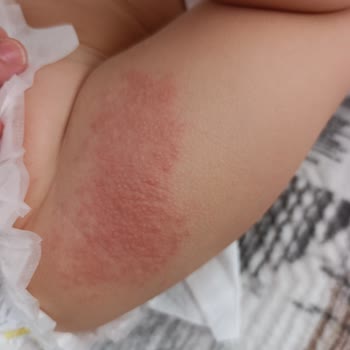 Sleepy Mayo Bezinde Şiddetli Bebek Cilt Tahrişi Ve Mantar Enfeksiyonu