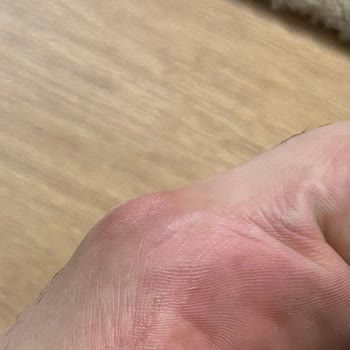 Kalıcı Ayak Ağrısı Ve Deformasyon Yaratan Puma Ayakkabı İçin İade Talebi