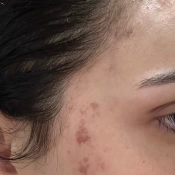 Ceren Serap Beauty’da Kimyasal Yanık Ve Saç Boyası Hatası