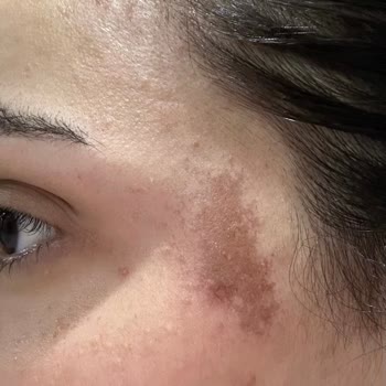 Ceren Serap Beauty’da Kimyasal Yanık Ve Saç Boyası Hatası
