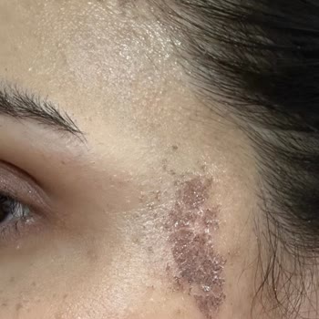 Ceren Serap Beauty’da Kimyasal Yanık Ve Saç Boyası Hatası