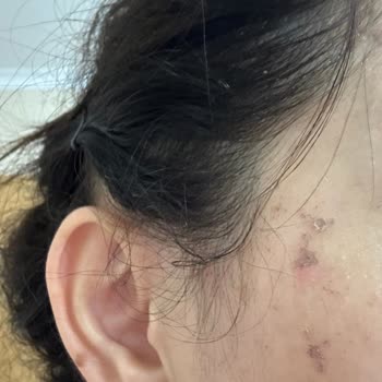 Ceren Serap Beauty’da Kimyasal Yanık Ve Saç Boyası Hatası