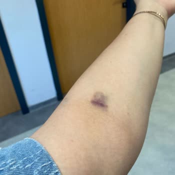 Acil Serviste Damar Yolu Açma Hataları Ve Morluklara Neden Olan Personel Tutumu