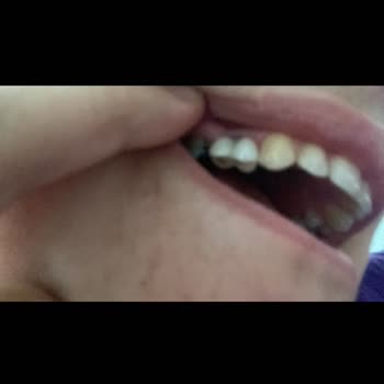 Alpi Diş Kaynarca Şubesinde İri Implant Dişi Ve Cevapsız Arama Sözleri