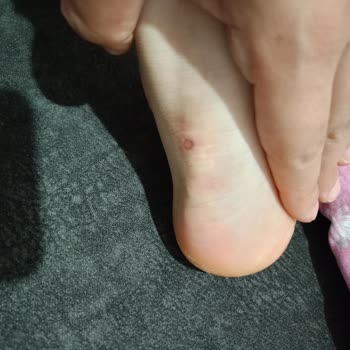 FLO Sneaker Ayak Yaralanmasına Neden Oldu, Değişim Ve İade Talebi