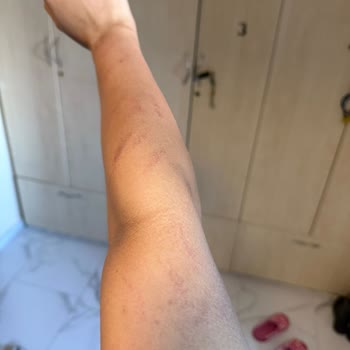 Lazer Epilasyon Sonrası Yanık Ve İz Şikayeti Cevapsız Bırakıldı