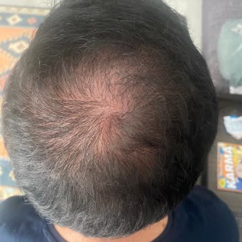 Donör Bölge Hasarı, Seyrek Saç Ekim Sonucu Ve Sorumluluk Reddi