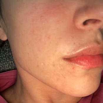 Caudalie Yüzümde Kaşıntı, Kızarıklık Ve Yanma Oluştu