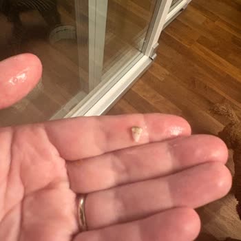 Baklavada Diş Parçası Bulunması Ve Yetersiz Açıklama