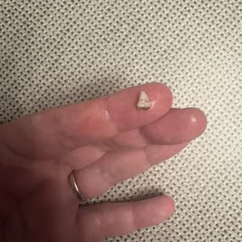 Baklavada Diş Parçası Bulunması Ve Yetersiz Açıklama