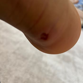 Ayakkabının Deforme Olması Ve Ayağımda Yara Oluşması Nedeniyle İade Talebimin Haksız Reddi