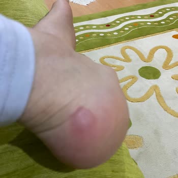 Derimod Ayakkabısında Sürekli Topuk Ağrısı Ve İade Talebinin Reddedilmesi