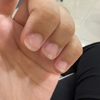 Akar Diamond’da Eksik Malzemeli Protez Tırnak, Erken Düşme Ve Çözüm Bulunamayan Şikayet