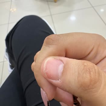 Akar Diamond’da Eksik Malzemeli Protez Tırnak, Erken Düşme Ve Çözüm Bulunamayan Şikayet