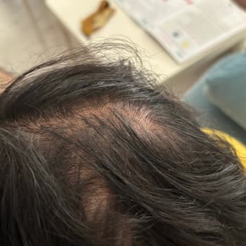 Şampuan Nedeniyle Şiddetli Saç Dökülmesi Ve Maddi-Manevi Mağduriyet