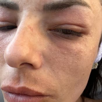 Nivea Luminous630 Ürünü Nedeniyle Göz Kapanması Ve Şiddetli Alerjik Reaksiyon