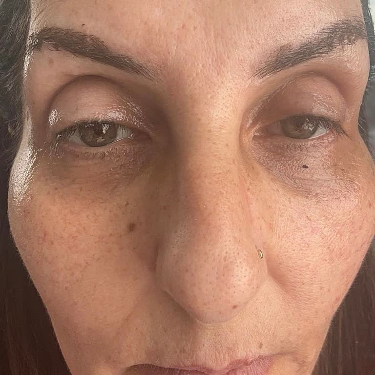 Mikropigmentasyon Sonrası Sağlık Sorunları Ve Kaş İşlemi İçin İade Talebi