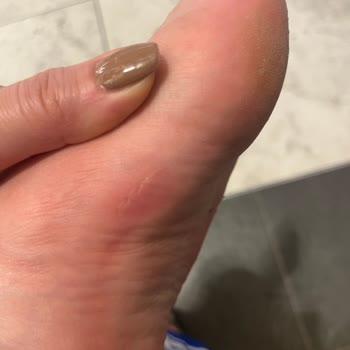 Birkenstock Arizona Terliği Kısa Sürede Yara Yaptı, İade Ve Değişim Talebi
