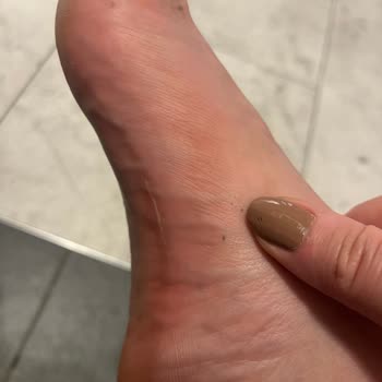 Birkenstock Arizona Terliği Kısa Sürede Yara Yaptı, İade Ve Değişim Talebi