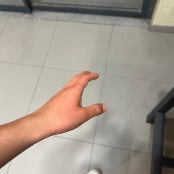 Burger King Sakarya Lavabosunda Kaynar Su Yanığı Ve Güvenlik İhmaline Dair Şikayet