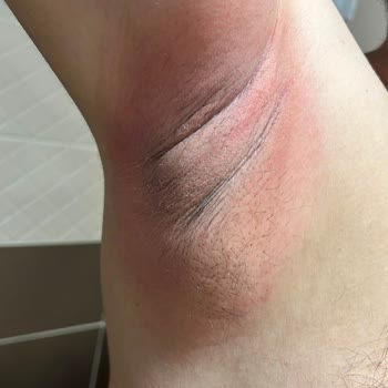 Yves Rocher Deodorantı Kullanımından Sonra Şiddetli Alerjik Reaksiyon