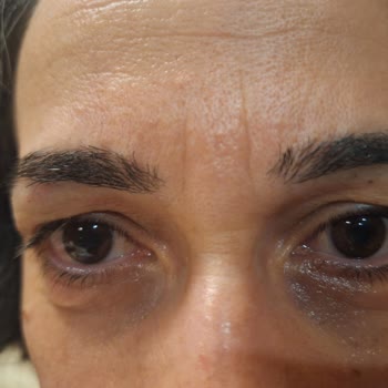 Bioderma Atoderm Eye Kullanımının Göz Çevresinde Kızarıklık Ve Şişlik Oluşturması